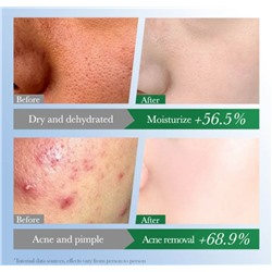 FAYANKOU Сыворотка для лица увлажняющая от прыщей и акне Centella Asiatica, 30мл.